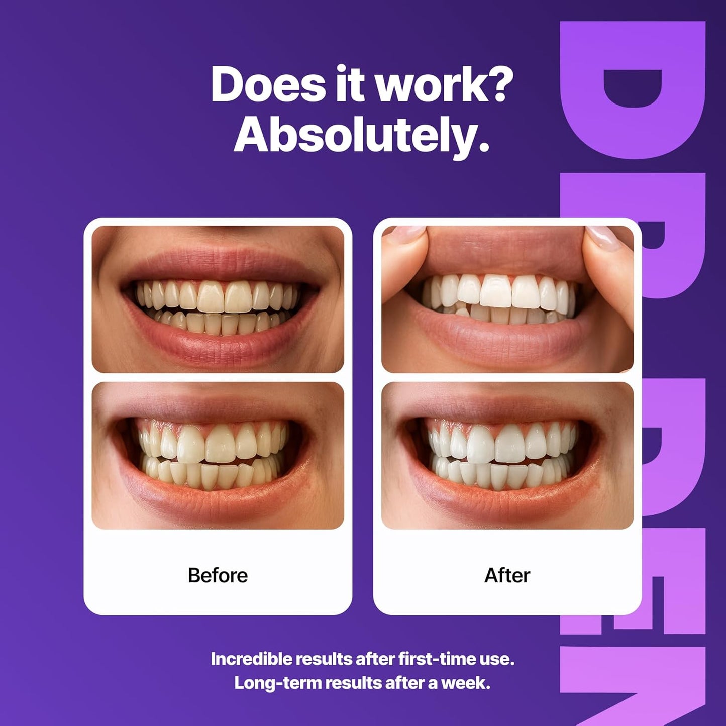 Teeth Whitening Strips