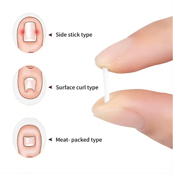 Toenail Correction Strips