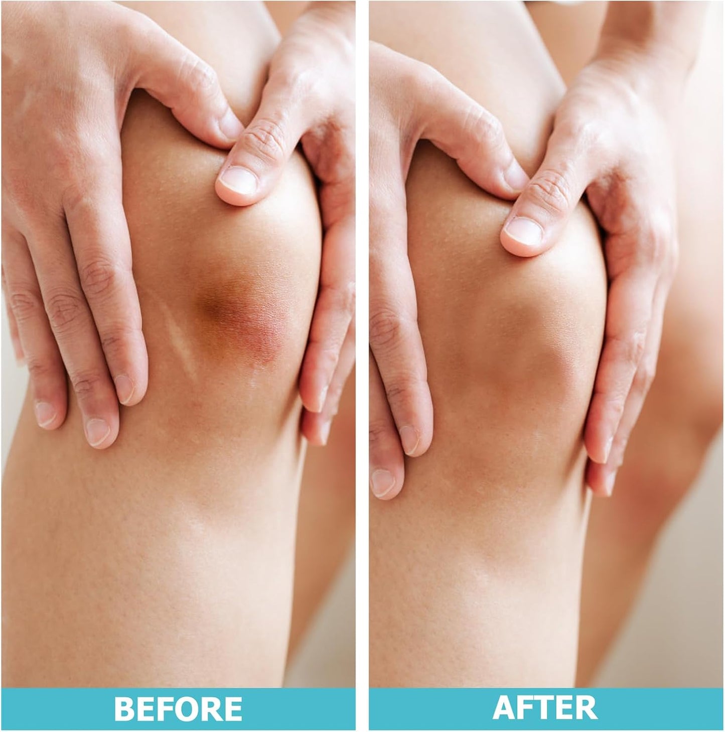 Hydrocolloid Roll for Wound Care